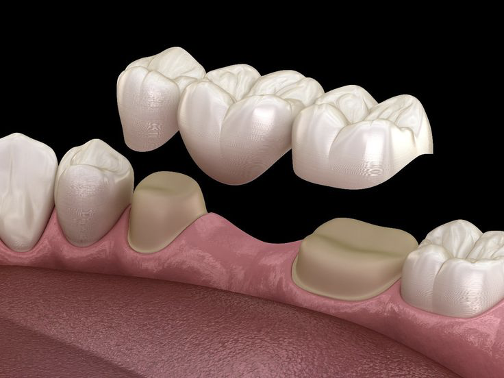 Prosthodontic Services
