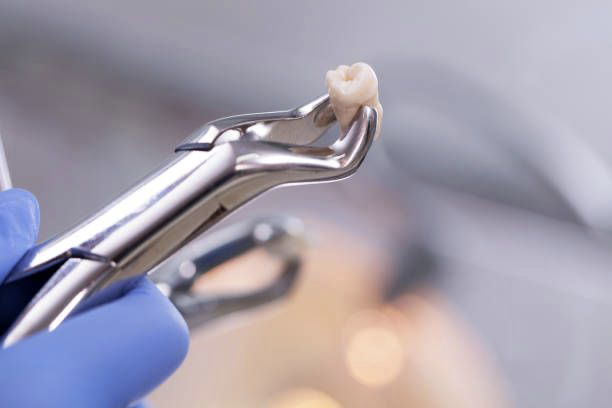 Tooth Removal Treatment