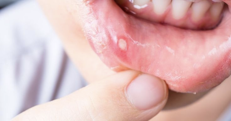 Treatment for Ulcers and Soft Tissue Lesions